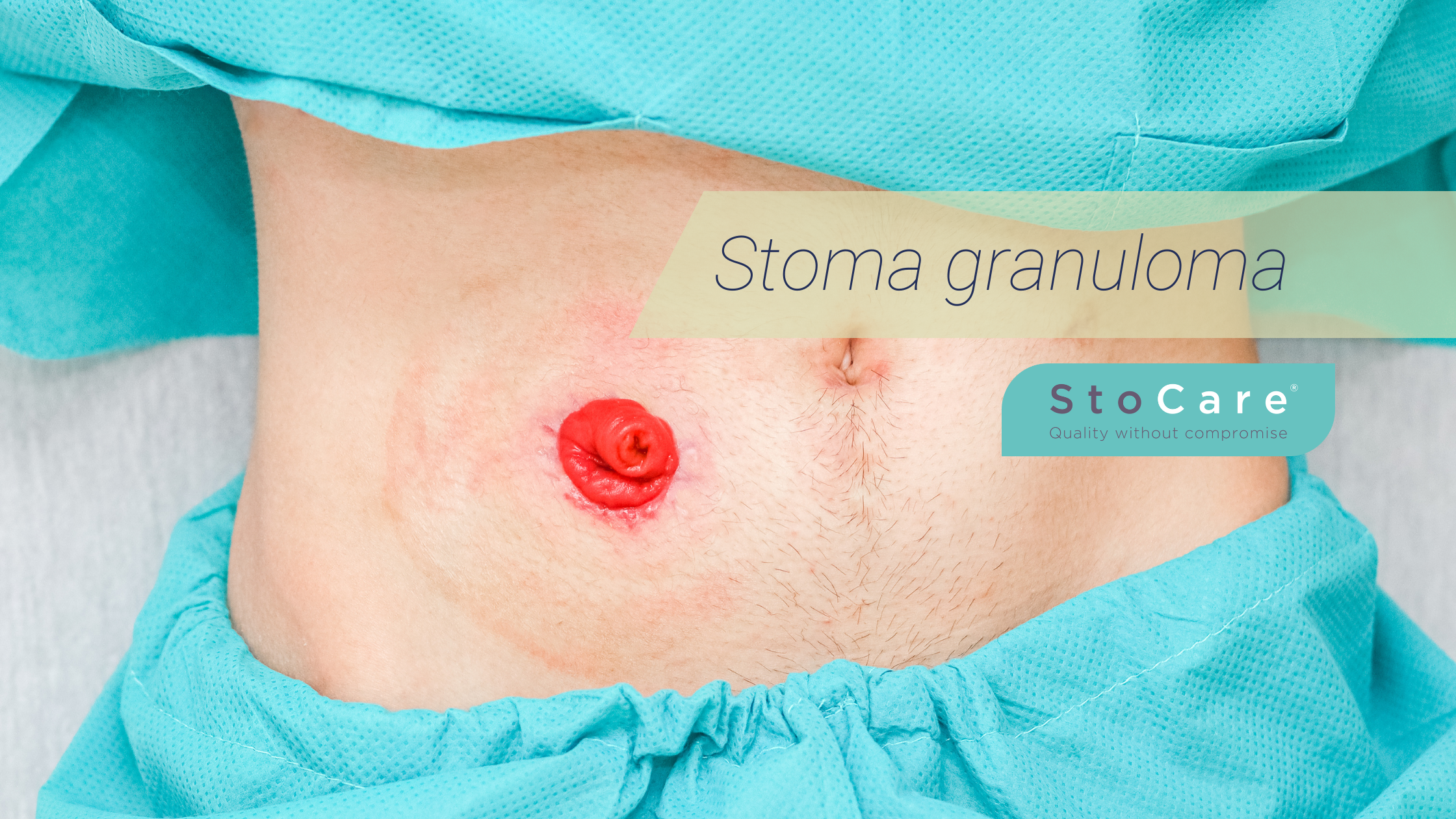 Prevenção: É Possível Evitar Granulomas? - inspiração 1