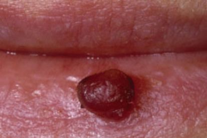 Por Que um Granuloma Aparece? As Causas Mais Comuns - inspiração 2