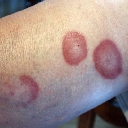 Tipos de Granulomas e Suas Diferenças - inspiração 1