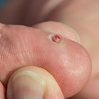 Tipos de Granulomas e Suas Diferenças - inspiração 2