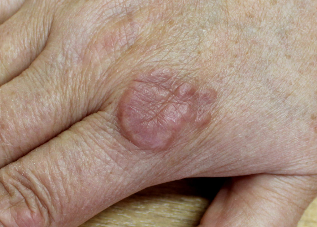 Granuloma Anular: Um Tipo Específico e Suas Características - inspiração 2