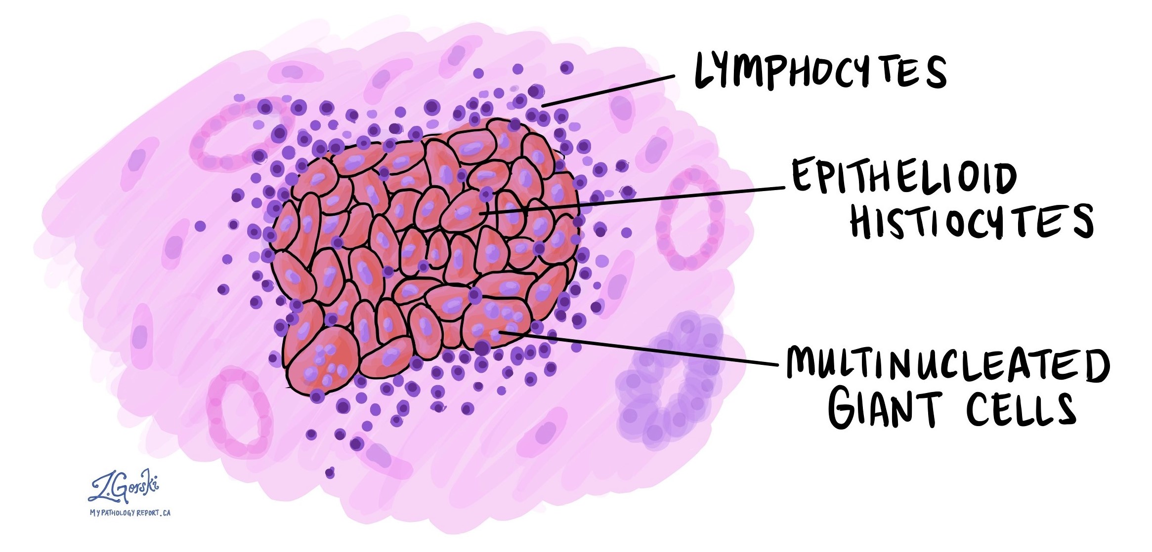 O Diagnóstico do Granuloma: Como o Médico Descobre? - inspiração 1