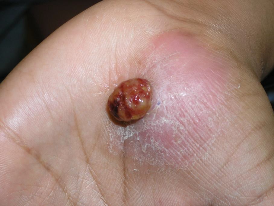 O Que Fazer Se Tiver um Granuloma? Dicas Práticas - inspiração 1