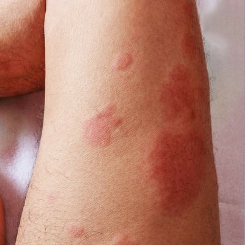 Descubra os tipos mais comuns de manchas vermelhas na pele - inspiração 1