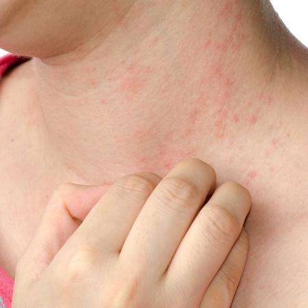 Tratamentos eficazes para vermelhidão e manchas - inspiração 1