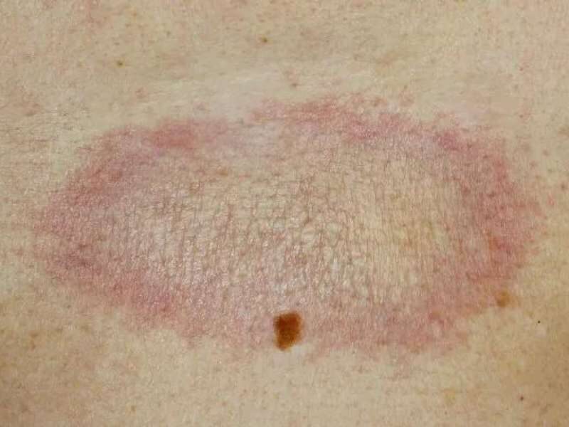 Rosácea: quando a vermelhidão se torna crônica - inspiração 1