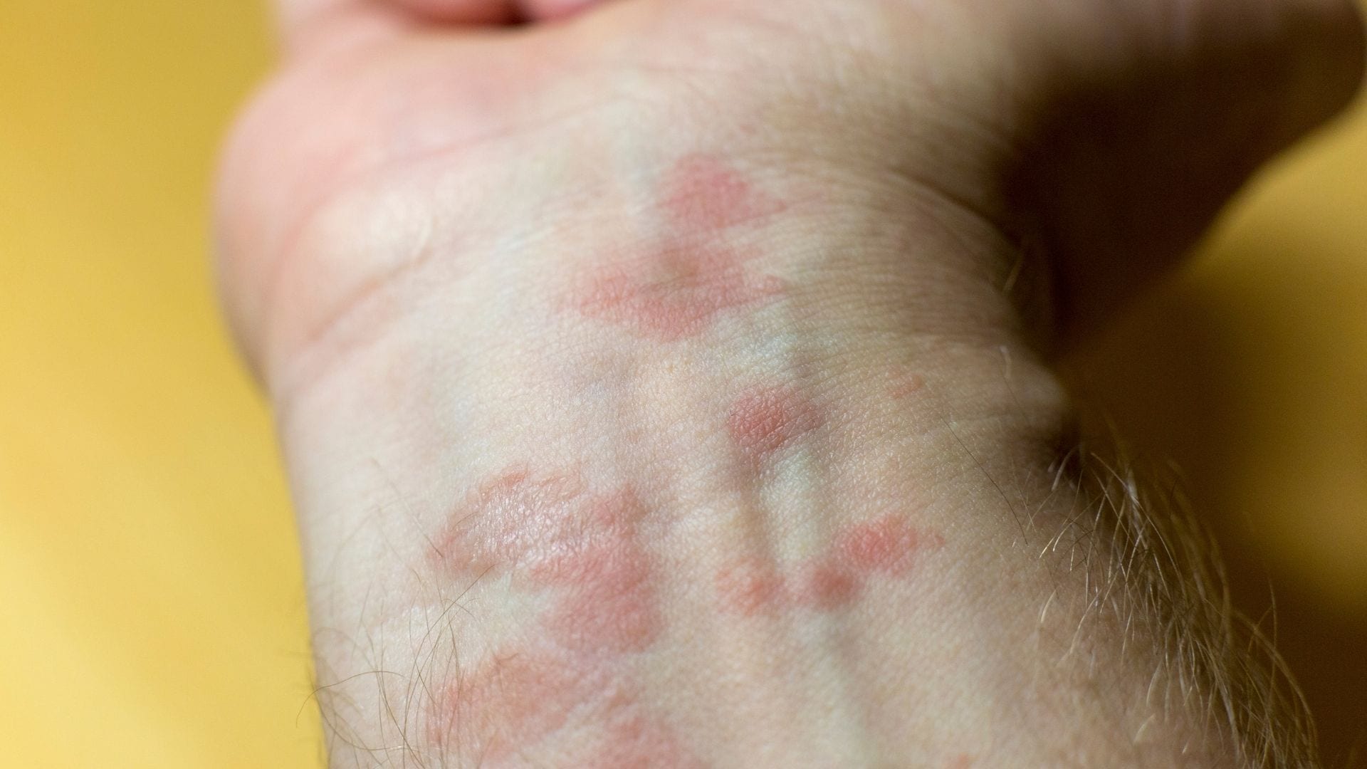 Dermatite: reações alérgicas e irritativas - inspiração 2