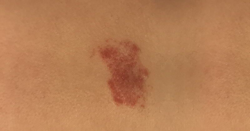 Psoríase: placas vermelhas com escamas - inspiração 2