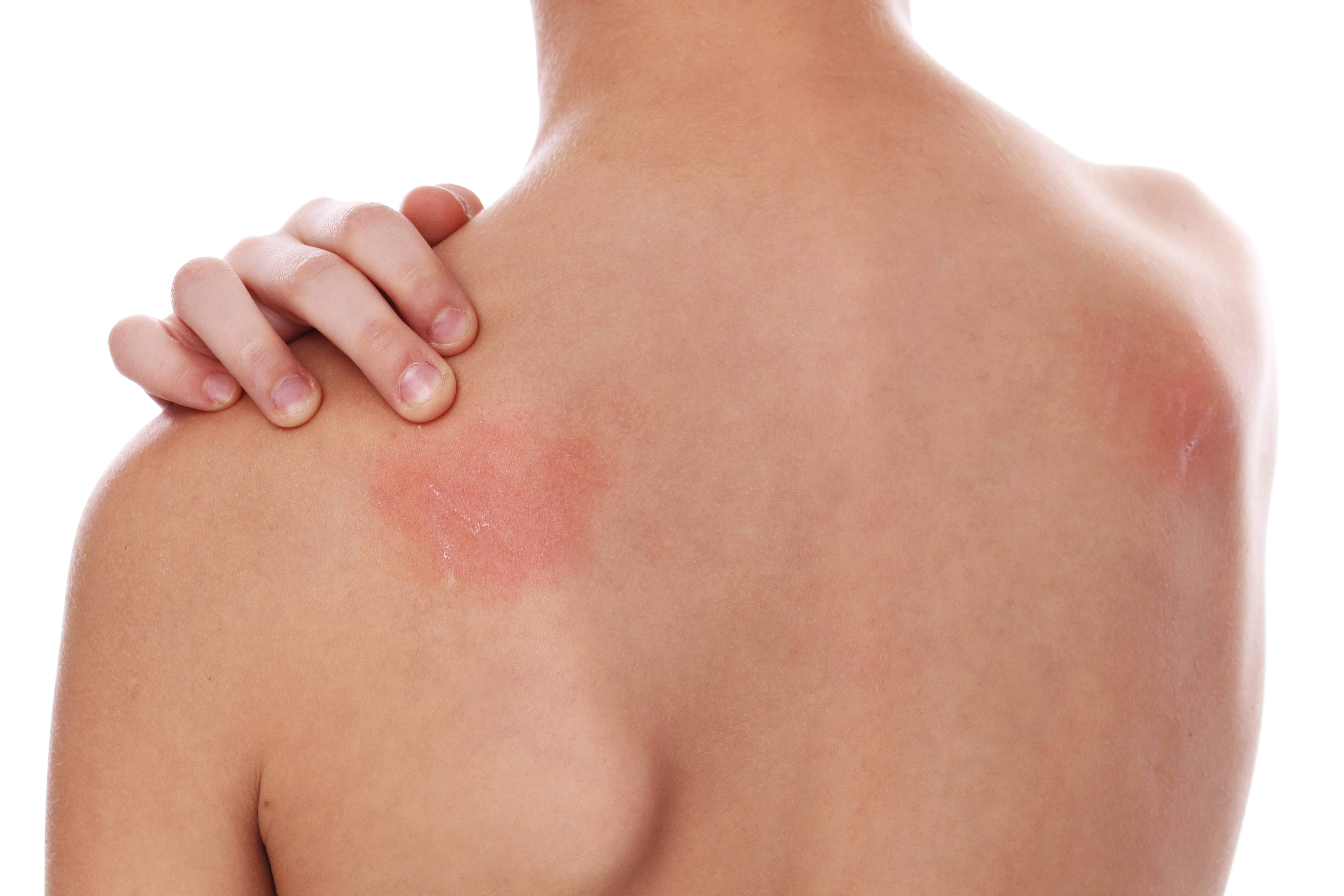 Acne e suas marcas vermelhas persistentes - inspiração 1