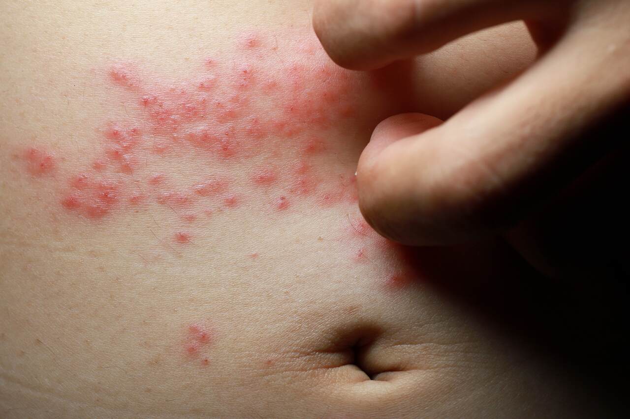 Manchas pós-inflamatórias: o rastro da cicatrização - inspiração 1