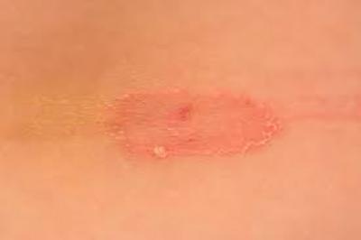 Manchas pós-inflamatórias: o rastro da cicatrização - inspiração 2