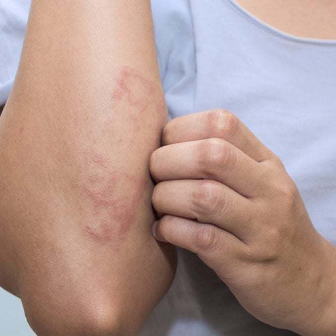 Doenças autoimunes e o aparecimento de lesões - inspiração 2