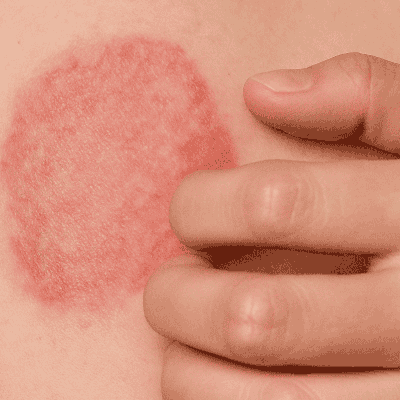 Micose nas Unhas: Sinais nas Mãos e Pés - inspiração 2