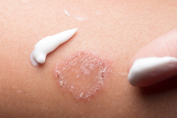 Micose no Couro Cabeludo: Queda de Cabelo e Descamação - inspiração 1