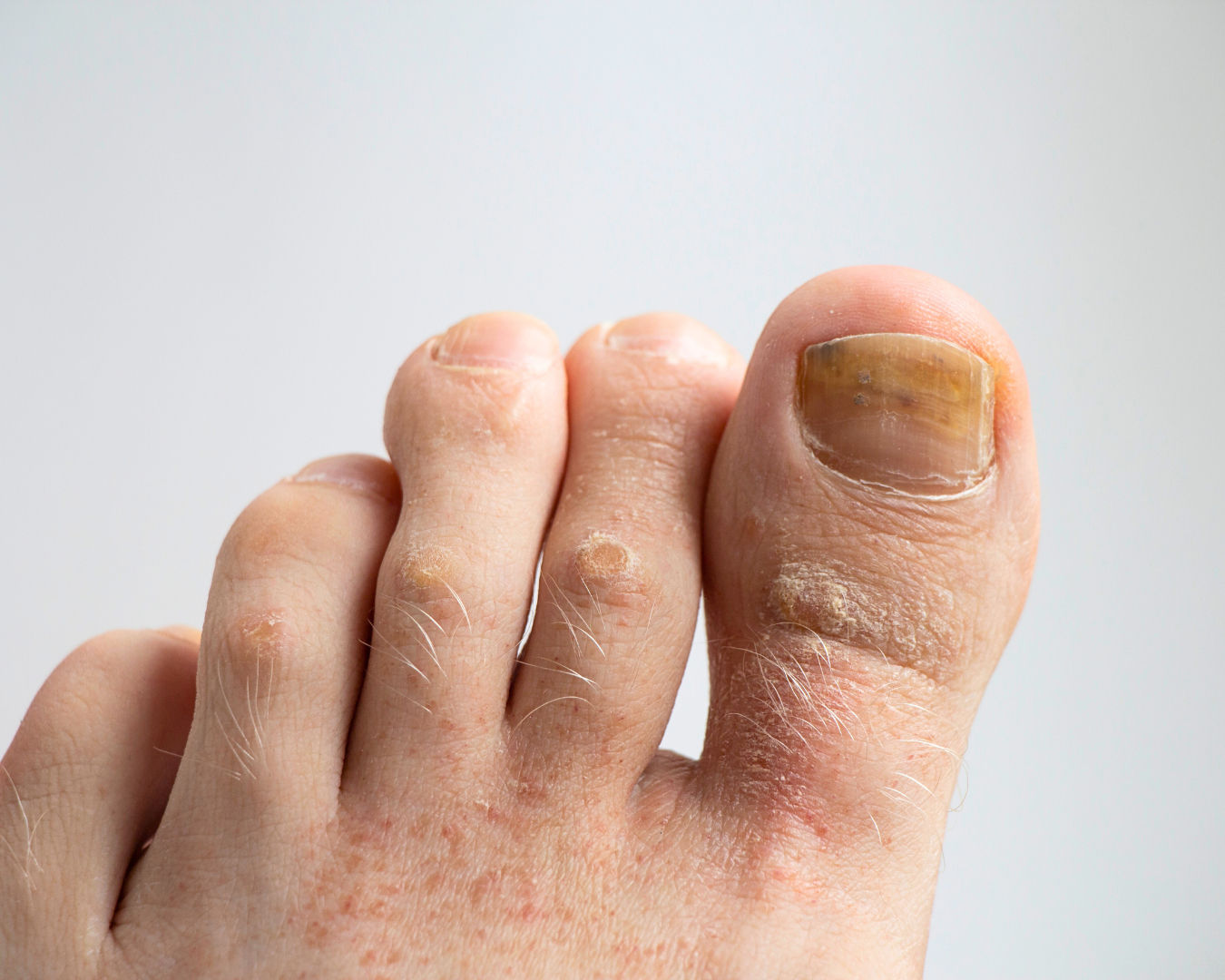 Micose nas Dobras da Pele: Atenção à Umidade - inspiração 1