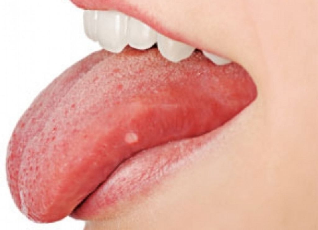 O Papel do Estresse e da Nutrição no Surgimento de Aftas