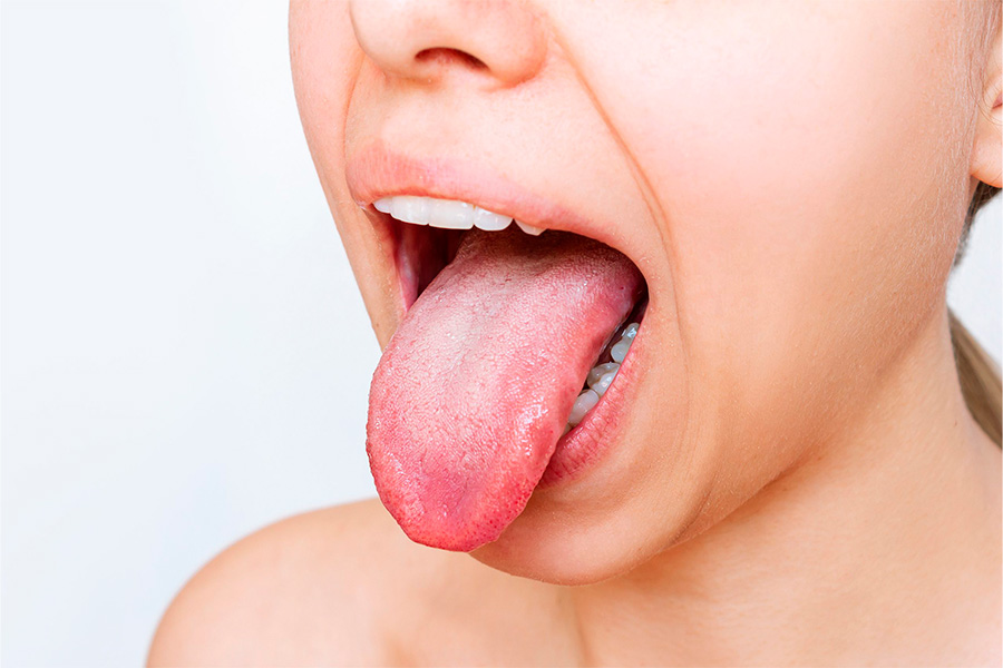 Afta na Língua: Quando a Preocupação é Real?
