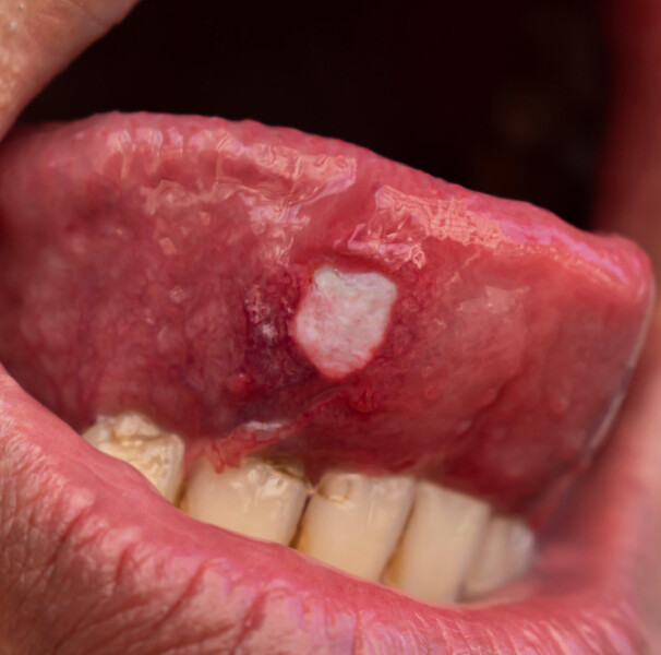 Remédios Caseiros Eficazes para Aliviar a Dor da Afta