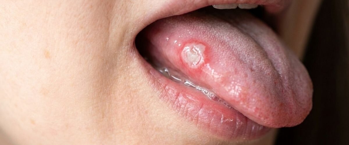 5 Alimentos que Pioram a Afta na Língua