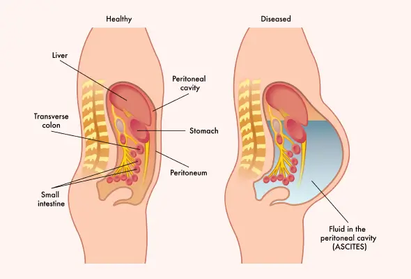 10 Sinais de que sua Barriga Inchada Pode Ser Ascite