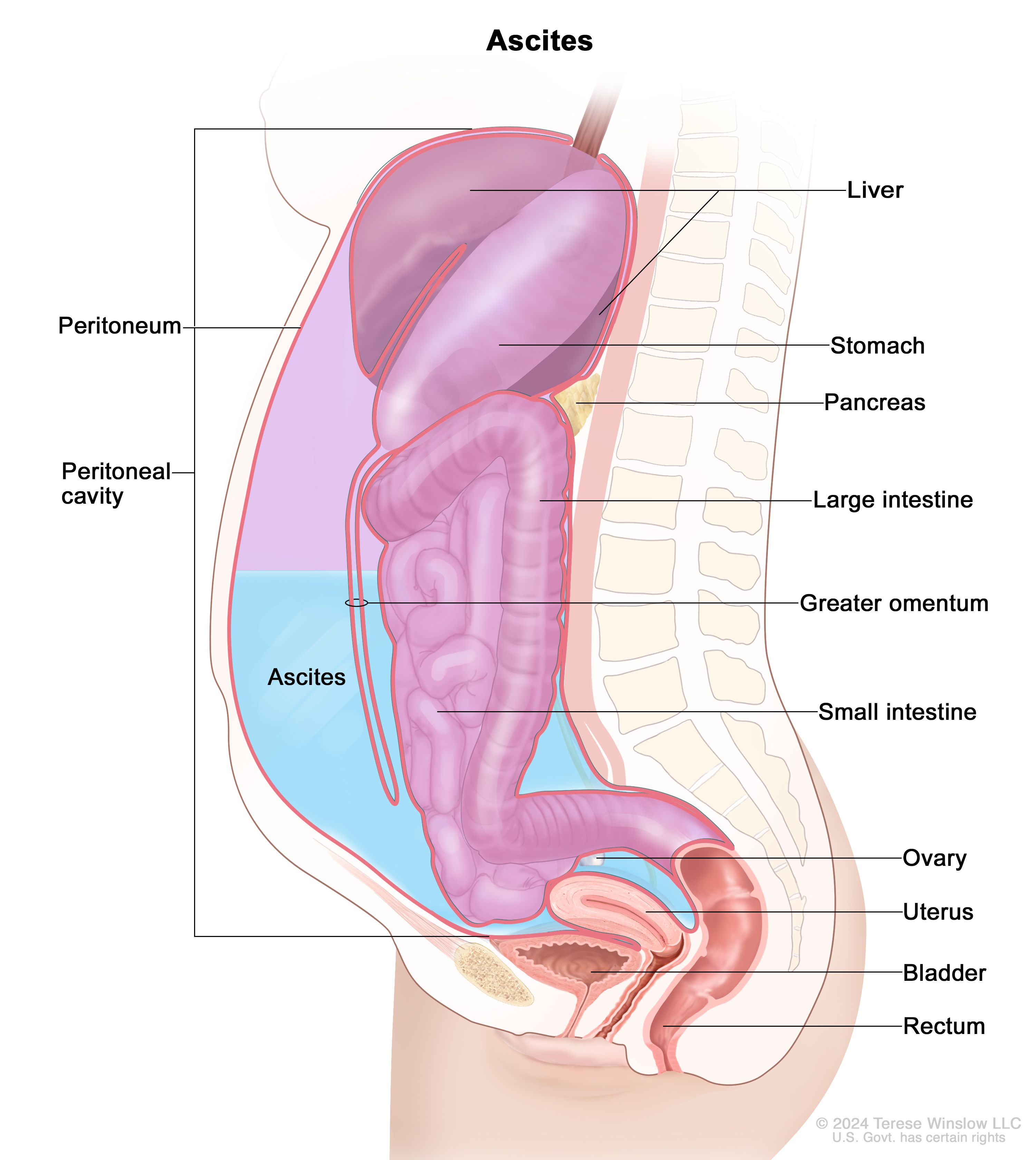 Ascite em Pacientes Oncológicos: Causas e Opções de Tratamento