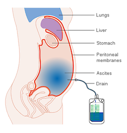 A Importância da Dieta Hipossódica no Manejo da Ascite