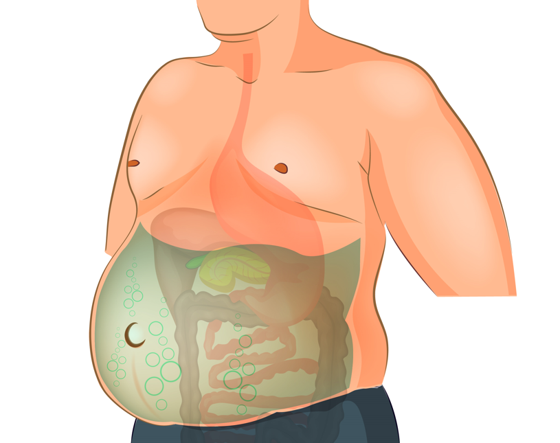 Como a Cirrose Hepática Leva à Ascite: Entenda a Relação