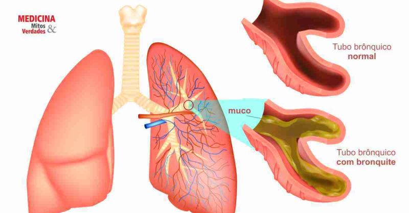 5 Mitos e Verdades sobre a Bronquite