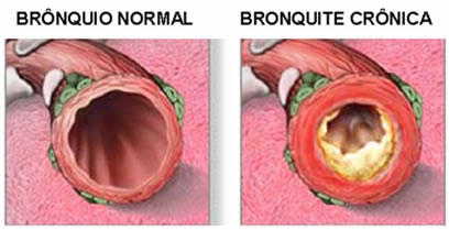 5 Mitos e Verdades sobre a Bronquite