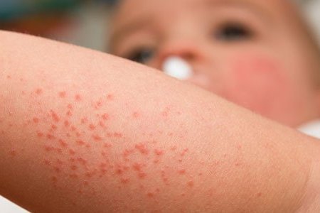 Brotoeja em Bebês: Causas e Cuidados Essenciais