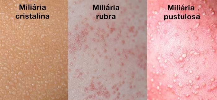 Dicas para Aliviar a Brotoeja em Adultos no Verão