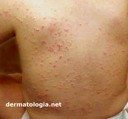 Quando a Brotoeja Precisa de Atenção Médica?