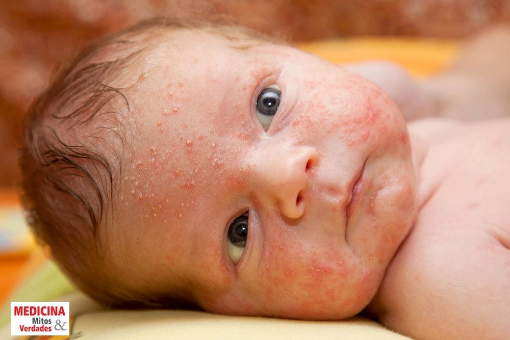 Diferenças entre Brotoeja e Alergia na Pele