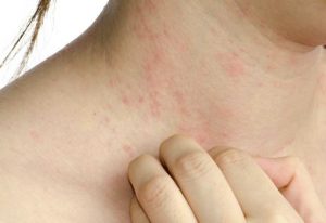 Remédios Caseiros Eficazes para Brotoeja