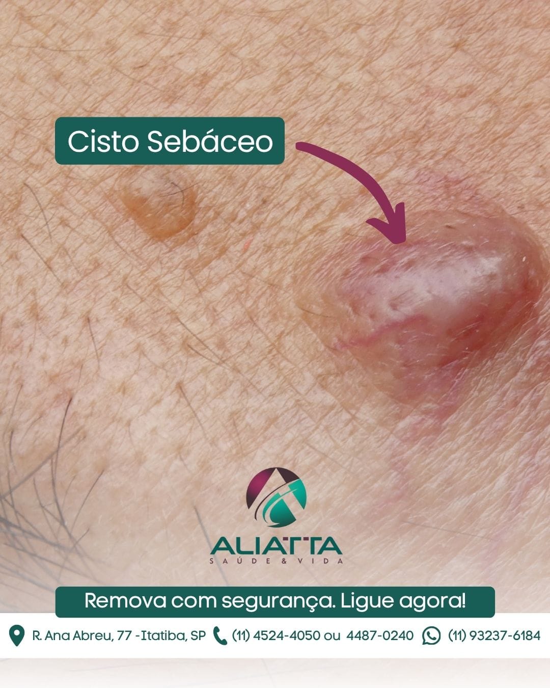 Como diferenciar cisto sebáceo de lipoma