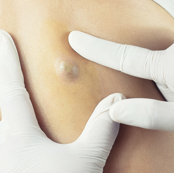 Pós-operatório da remoção de cisto sebáceo