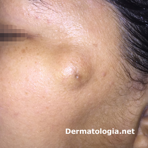 Causas do surgimento de cistos sebáceos