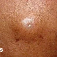 Pós-operatório da remoção de cisto sebáceo