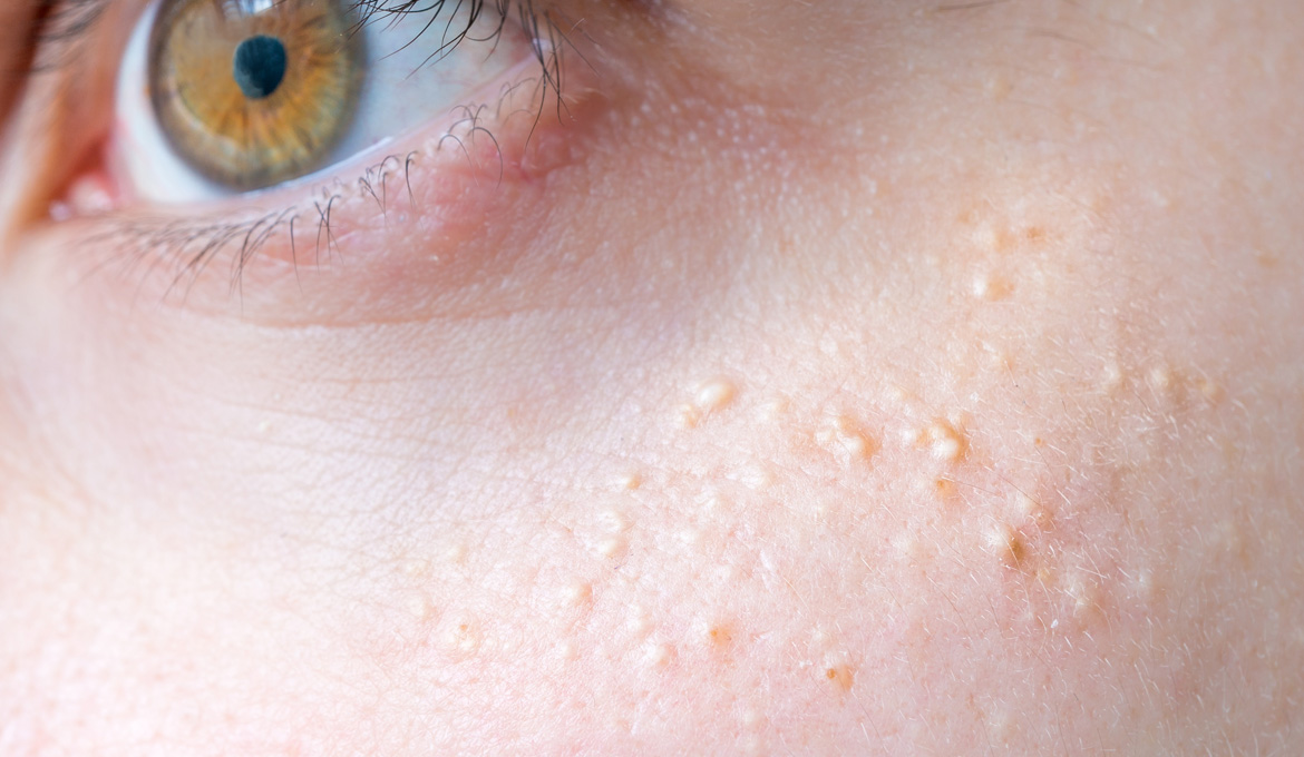 Causas do surgimento de cistos sebáceos