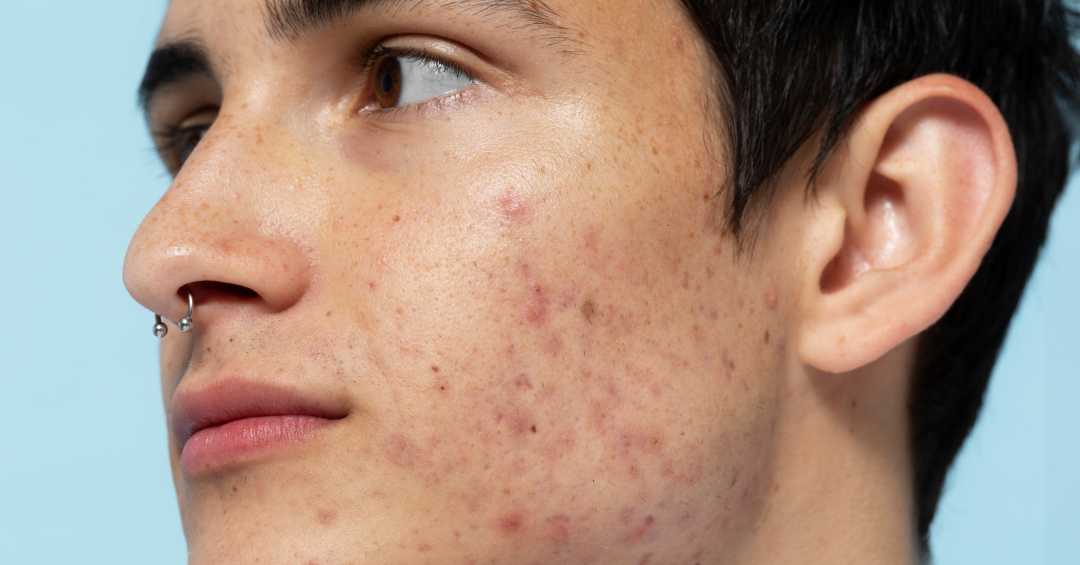 Como Usar Ácido Salicílico na Rotina de Skincare