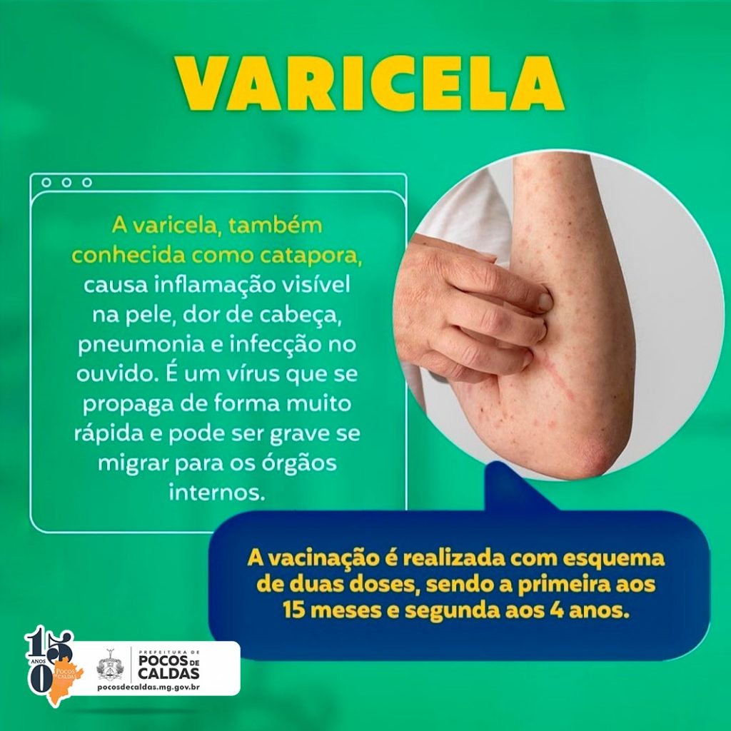 Guia Completo da Vacinação Infantil Contra a Catapora