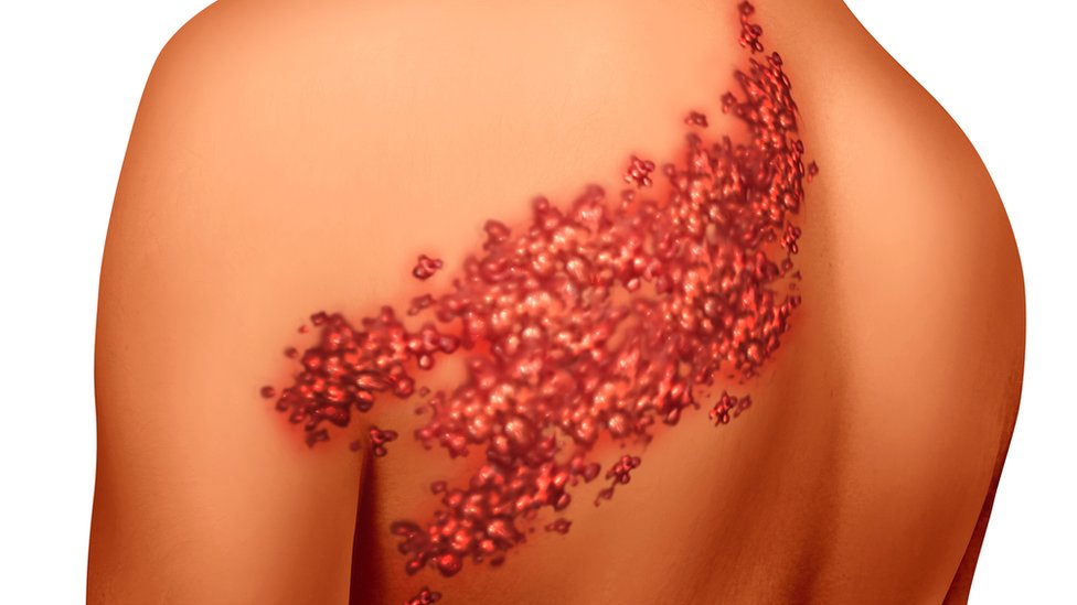 Mitos e Verdades Sobre a Vacina da Catapora