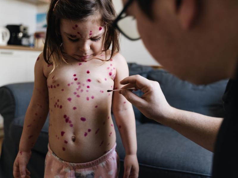 Entenda a diferença entre Catapora e Herpes Zóster