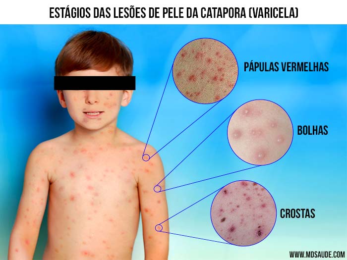 Guia Completo da Vacinação Infantil Contra a Catapora