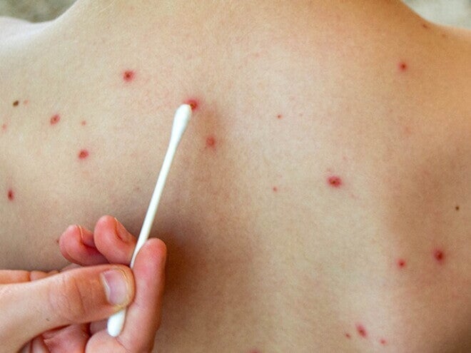 Como aumentar a imunidade contra a rubéola