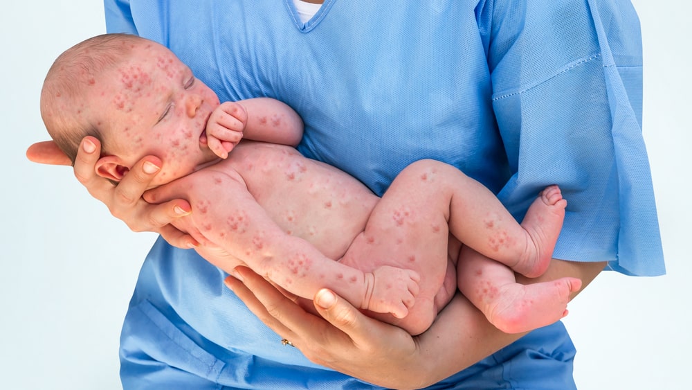 Entenda a Síndrome da Rubéola Congênita e seus Riscos