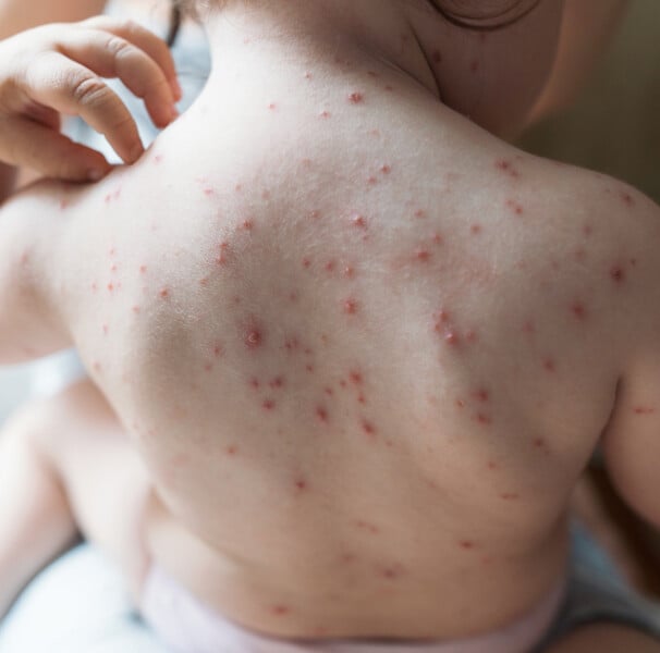 Guia Completo da Vacina Tríplice Viral (SCR)