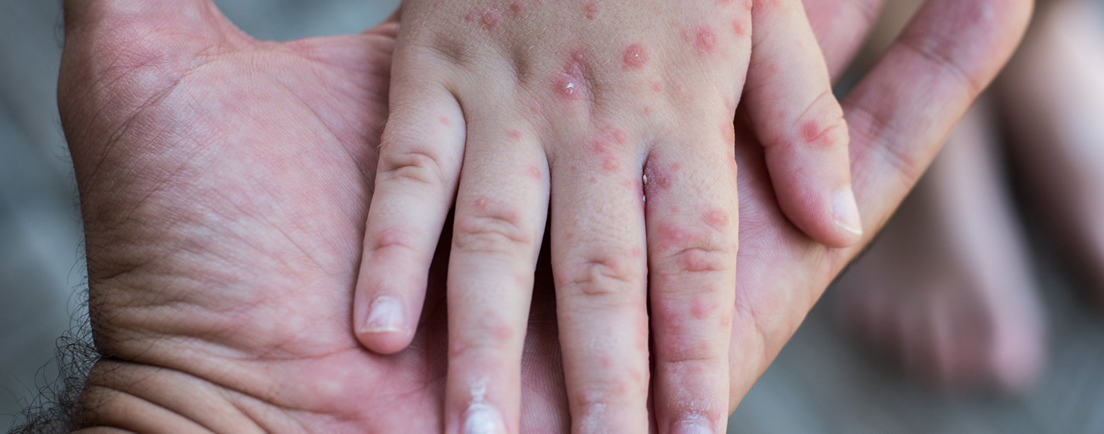 Como aumentar a imunidade contra a rubéola