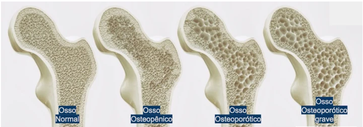 Como a Vitamina D Impacta a Densidade Óssea na Pós-Menopausa