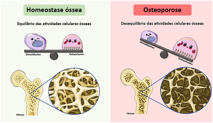 Mitos e Verdades sobre a Osteoporose